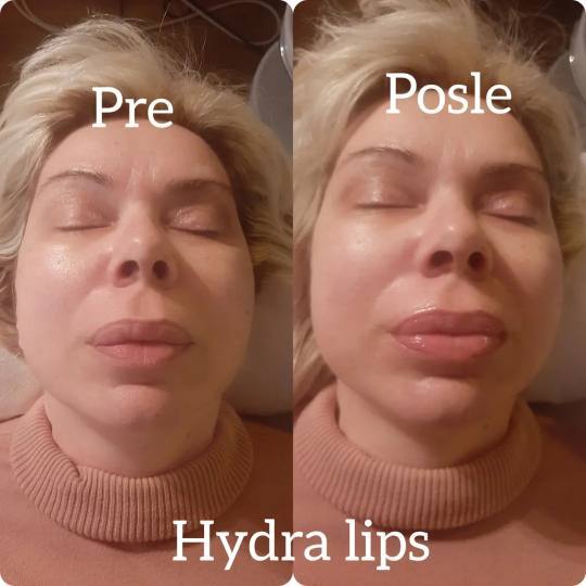 Studio Venera J #beograd Tretman lica Derm fix - Hydra lips tretman - tretman za negu ispucalih i su