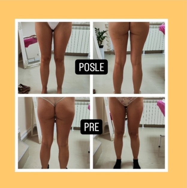 Mademoiselle Natalie studio #beograd Anticelulit LUX 10 maderoterapije+10 limfne drenaze+ brazilske madero+10 pakovanja