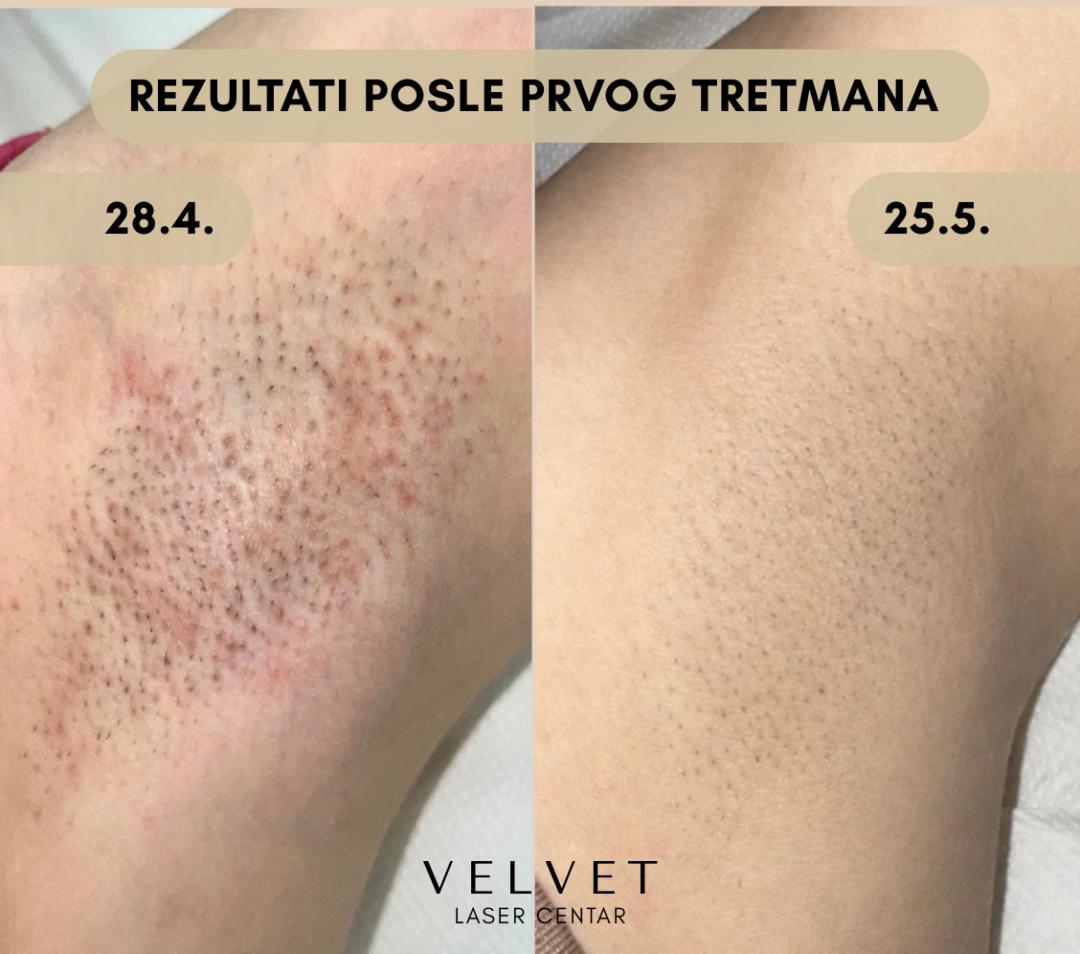 Laserska epilacija pazuha - za dame - Velvet, Beograd Laserska epilacija Depilacija Laserska epilacija, Beograd, Slavija, Autokomanda, Neimar