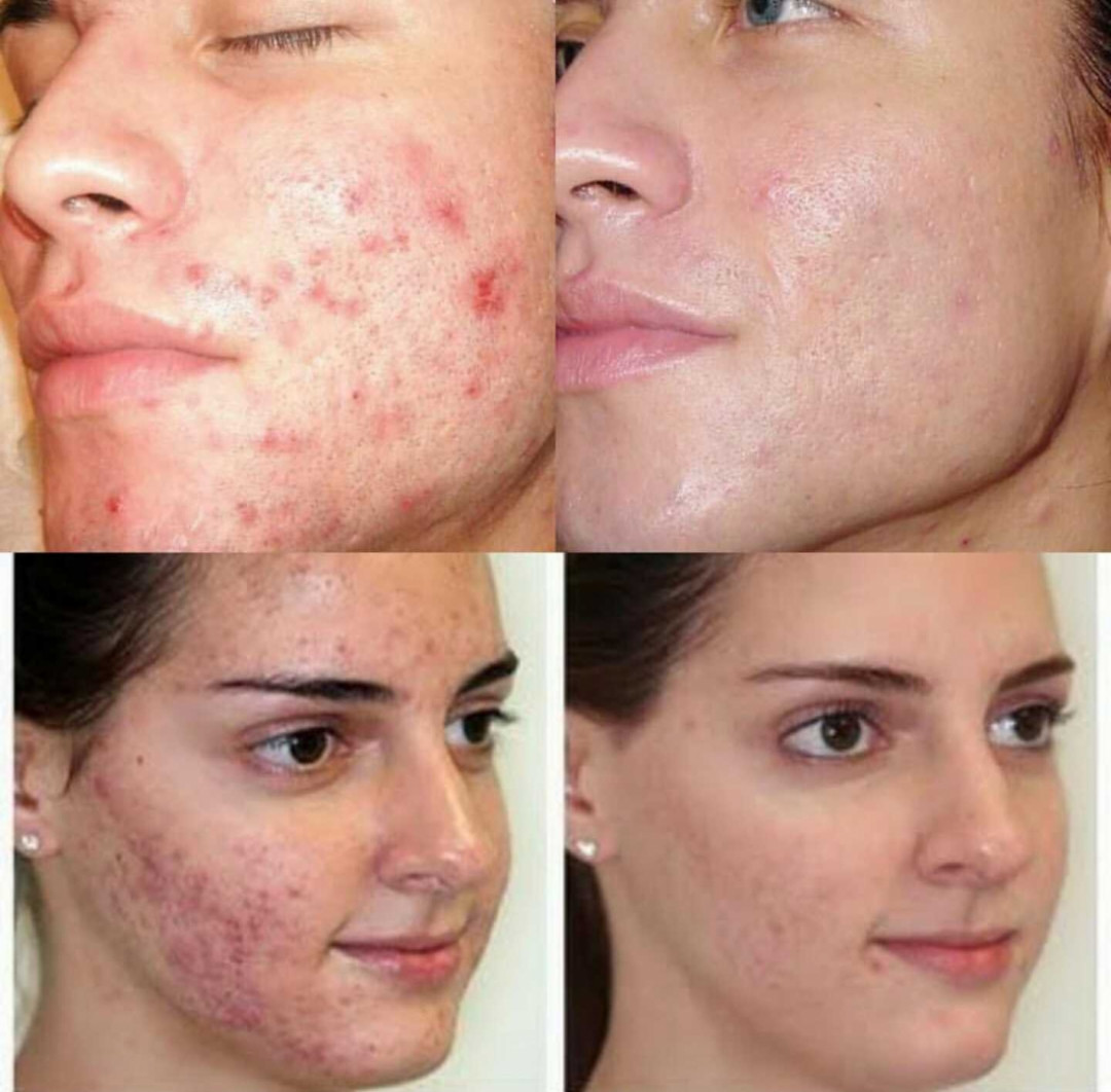 Grossi cosmetic #beograd Mikrodermoabrazija