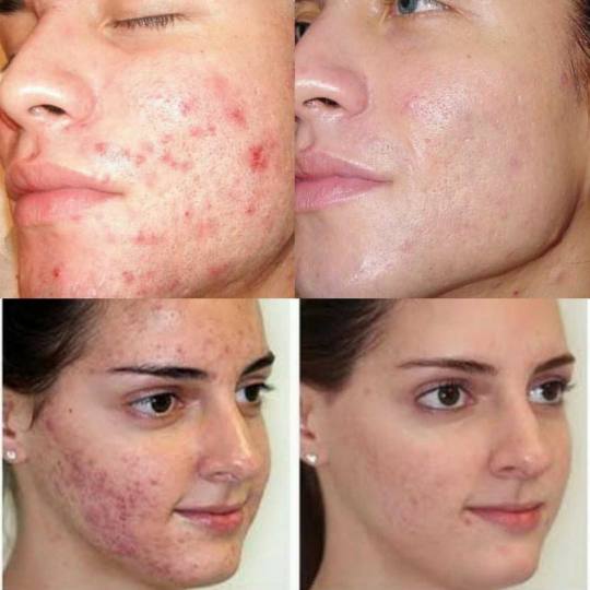 Grossi cosmetic #beograd Mikrodermoabrazija