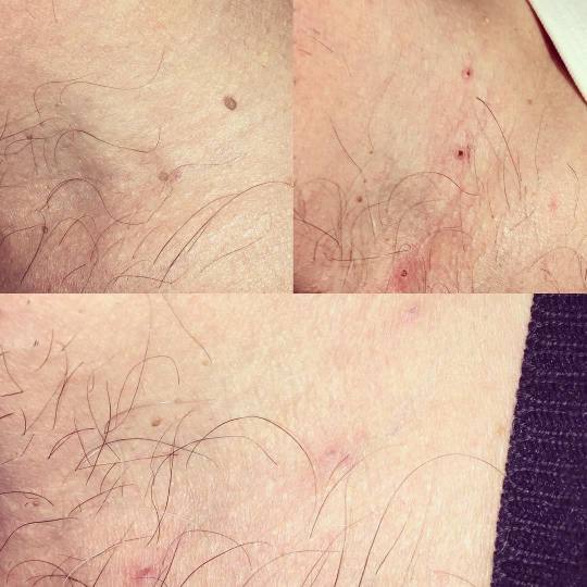Ashanti Beauty Salon & Academy #beograd Tretman lica Plasma pen - skidanje do 5 bradavica