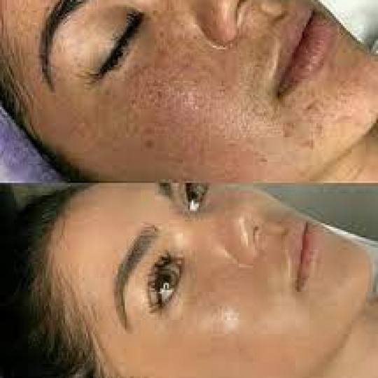 Vila Beauty Studio #beograd Dermaroler i dermapen Dermapen tretman lica