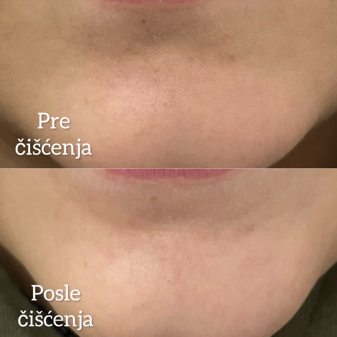 Estetski centar Vlahović #beograd Tretman lica Čišćenje lica ( svi tipovi kože ) aparaturni tretman
