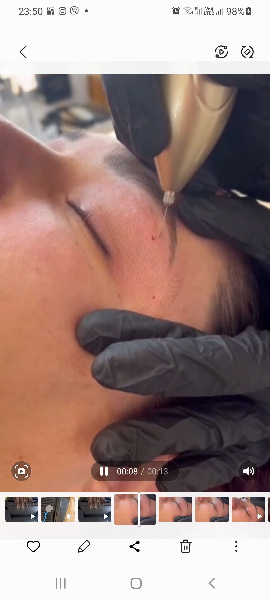 Esthetique Privé #beograd Tretman lica Plazma pen - po regiji