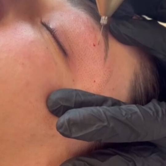 Esthetique Privé #beograd Tretman lica Plazma pen - po regiji Plazma pen tretman za zatezanje kože