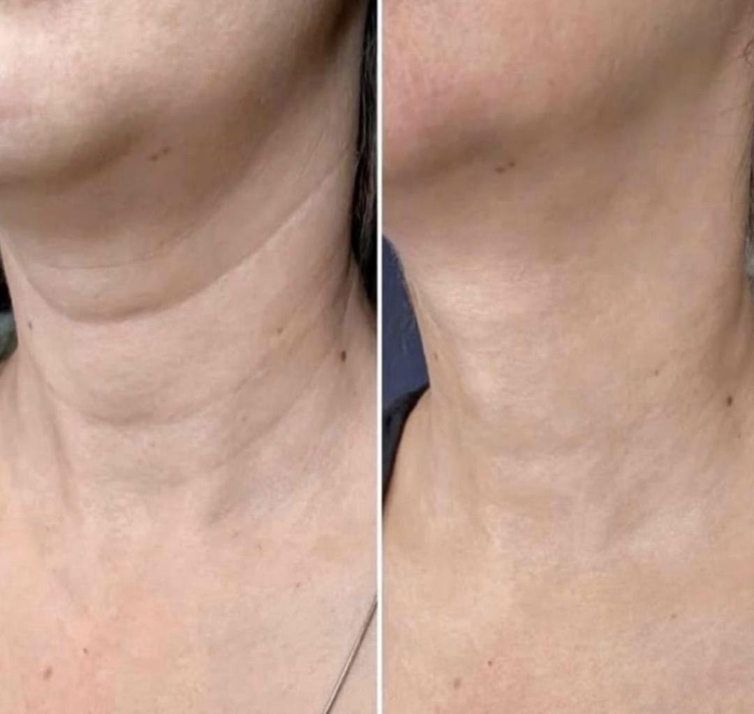 Amelini beauty concept #beograd Radiotalasni i ultrazvučni tretmani Radiotalasni lifting lica - paket od 6 tretmana