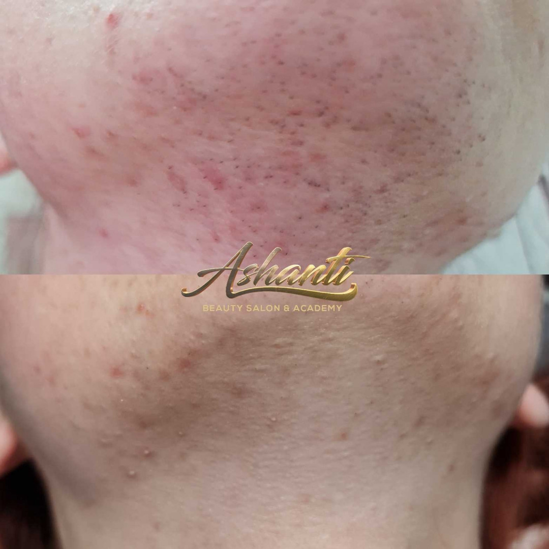 Ashanti Beauty Salon & Academy #beograd Laserska epilacija Laserska epilacija brade + podbrade
