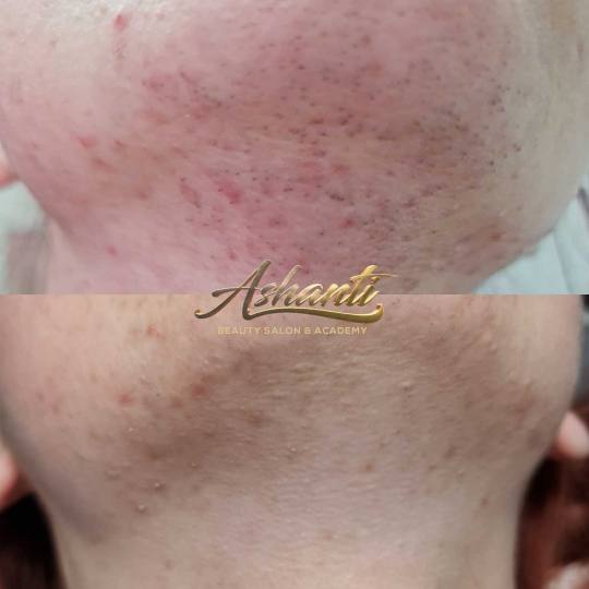 Ashanti Beauty Salon & Academy #beograd Laserska epilacija Laserska epilacija brade + podbrade Rezul