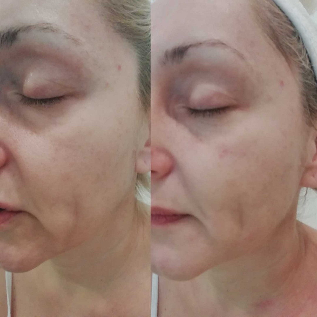 Olja Beauty #beograd Lifting / zatezanje kože HiFu tretman lica - po regiji