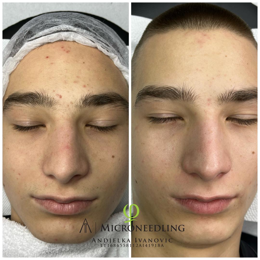 Microneedling tretman - lice - Belle Ana, Beograd Tretman lica Lice Tretman lica, Beograd, Vračar, Čubura, Crveni krst
