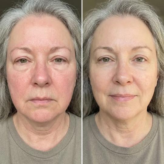 Beauty Glam House #nis Tretmani protiv bora Hifu tretman - lice