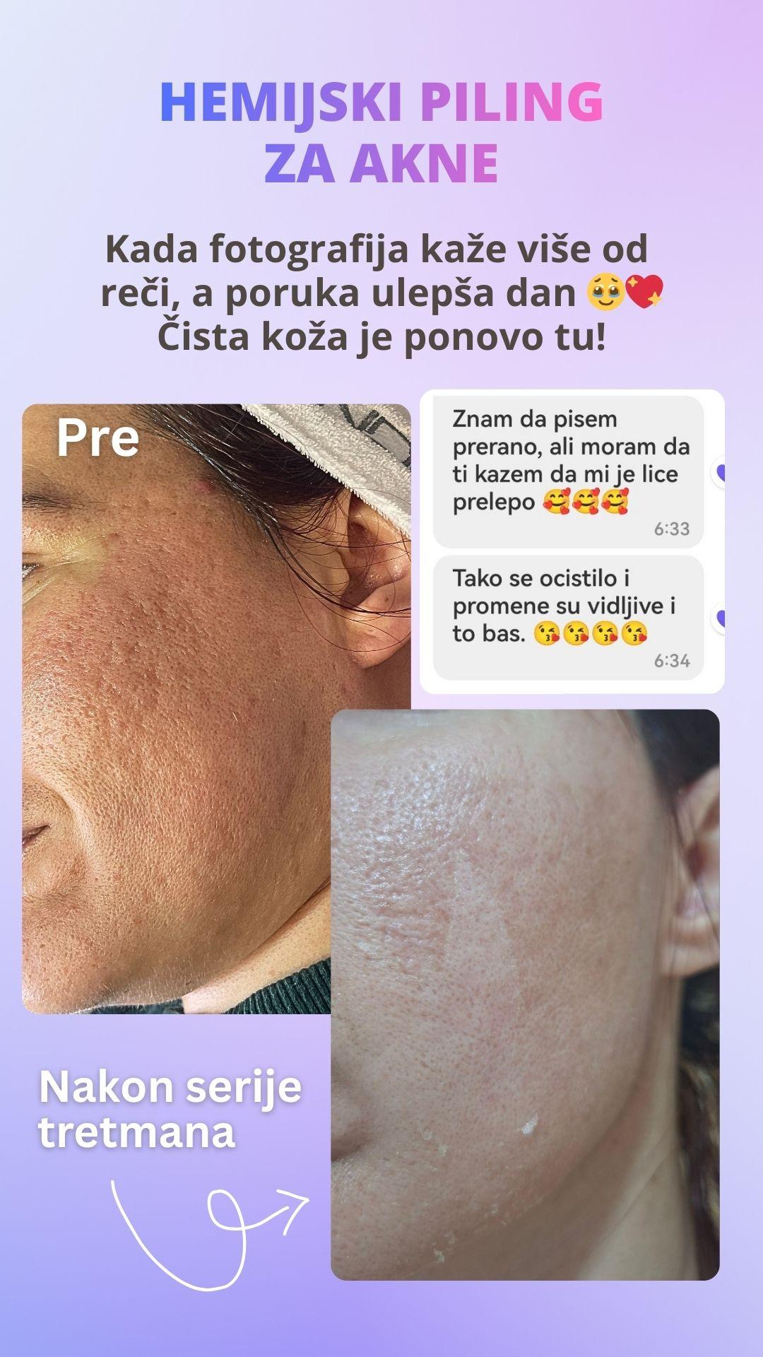 Hemijski piling za akne - Beauty in Style DM, Novi Sad Tretman lica Lice Tretman lica, Novi Sad, Sajmište, Detelinara, Banatić