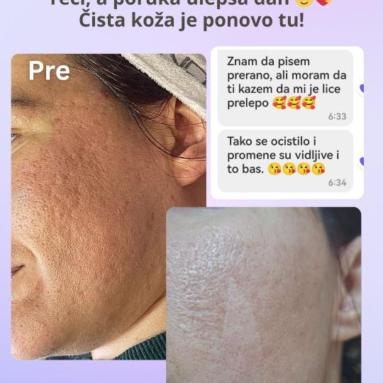 Beauty in Style DM #novisad Tretman lica Hemijski piling za akne