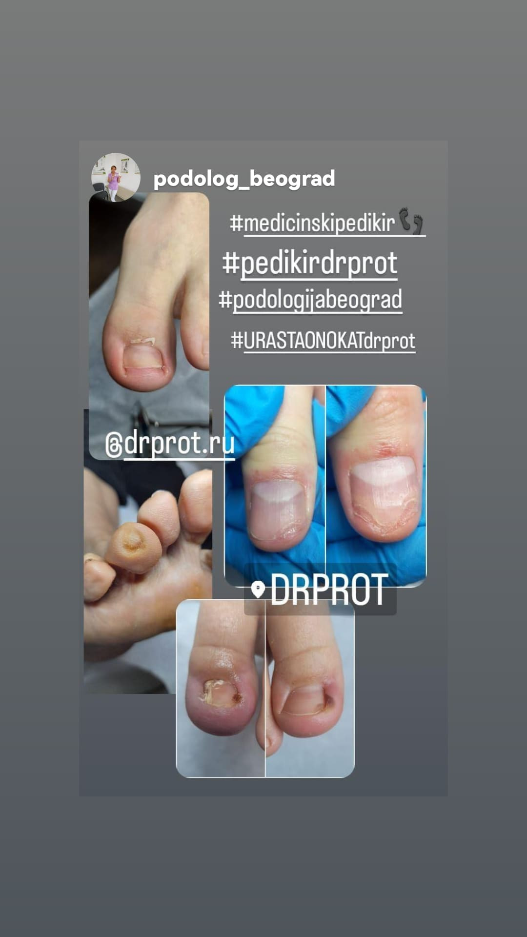 Dr. Prot #beograd Medicinski pedikir Medicinski pedikir - problematičan