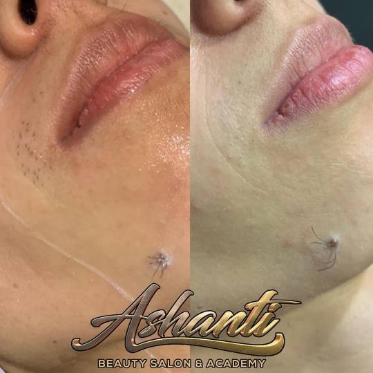 Ashanti Beauty Salon & Academy #beograd Laserska epilacija Laserska epilacija celog lica