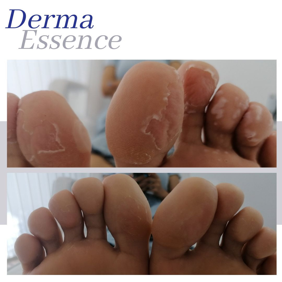 Derma Essence #nis Estetski pedikir Standardni pedikir