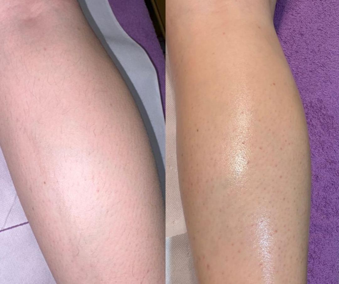 Angels #novisad Depilacija nogu Depilacija celih nogu toplim voskom - za dame