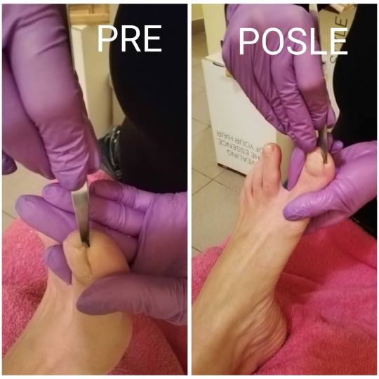 Vanila M #novisad medicinski pedikir