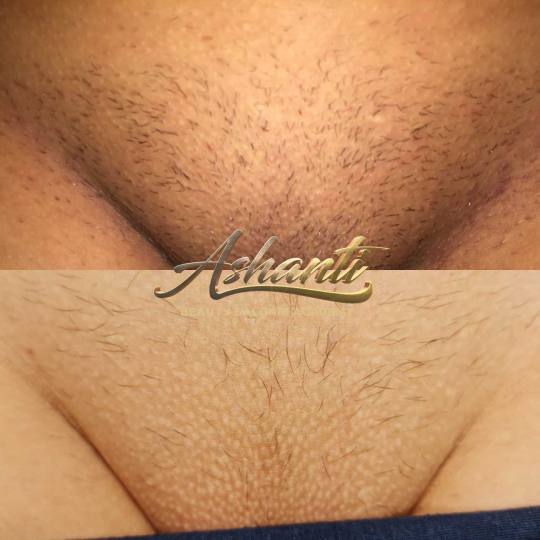 Ashanti Beauty Salon & Academy #beograd Laserska epilacija Brazilska laserska epilacija Slika pre pr