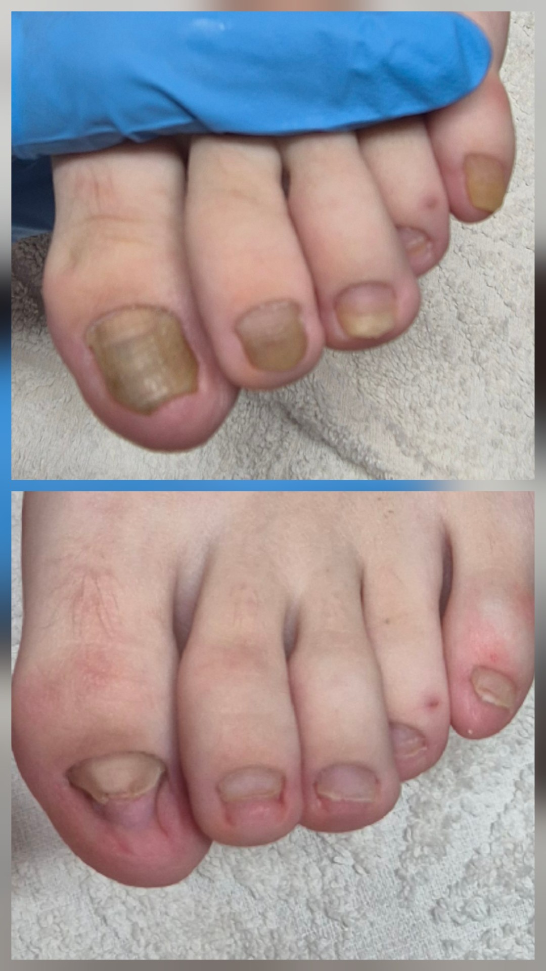 Medicinski pedikir - više problematičan - Bellavana studio, Kruševac Medicinski pedikir Nokti Medicinski pedikir, Kruševac, Centar