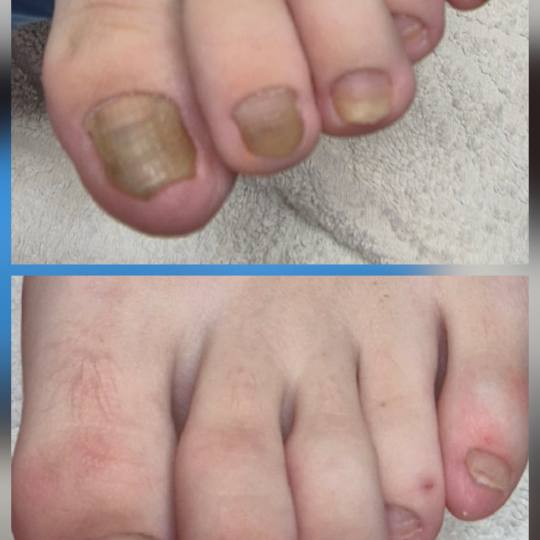 Bellavana studio #krusevac Medicinski pedikir Medicinski pedikir - više problematičan