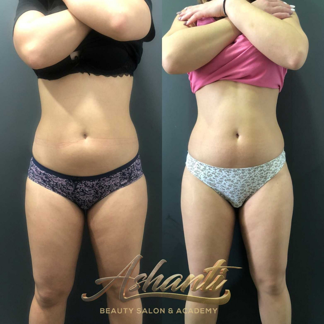 Ice Body Sculpting - Ashanti Beauty Salon & Academy, Beograd Tretmani tela Telo Tretmani tela, Beograd, Voždovac