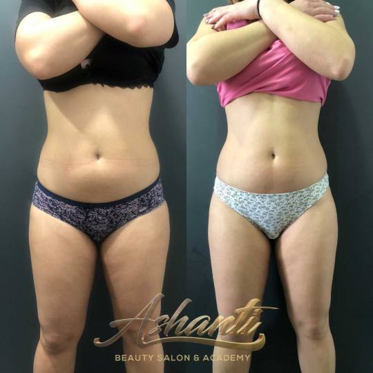 Ashanti Beauty Salon & Academy #beograd Tretmani tela Ice Body Sculpting