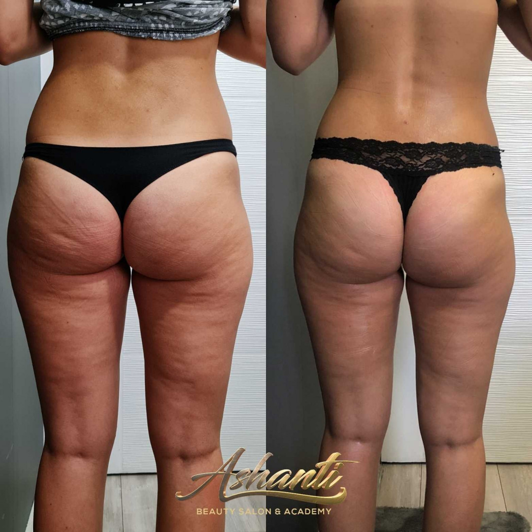 Ashanti Beauty Salon & Academy #beograd Masaža za mršavljenje Dermapen - regija lica