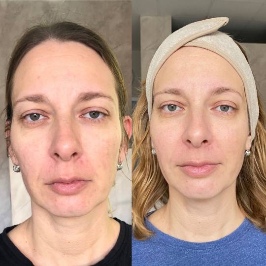Makeup Olja Grbić #novisad Tretman lica Face gym masaža pocetno stanje i stanje nakon dve masaze! 