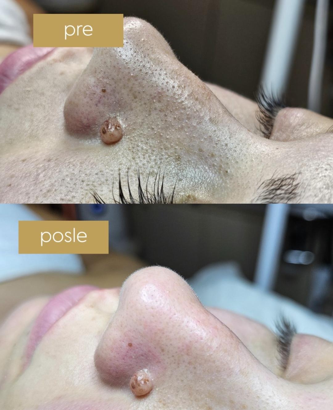 Higijenski tretman lica sa mikrodermoabrazijom - Beautique spa, Beograd Tretman lica Lice Tretman lica, Beograd, Novi Beograd blokovi, Belville, Savski kej