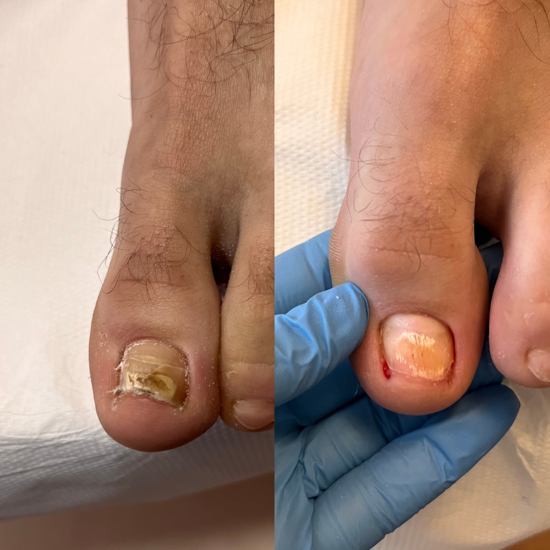 Beauty Derma MKK #beograd Medicinski pedikir Medicinski pedikir - više problematičan