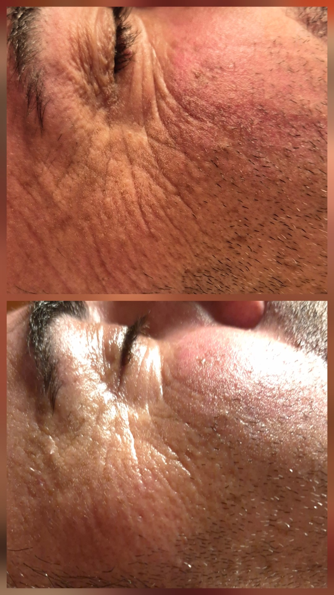 Bellavana studio #krusevac Lifting / zatezanje kože Skulpturalni face lifting