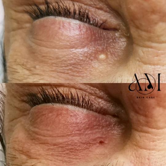 AM BEAUTY STUDIO #odzaci Tretman lica Uklanjanje milija