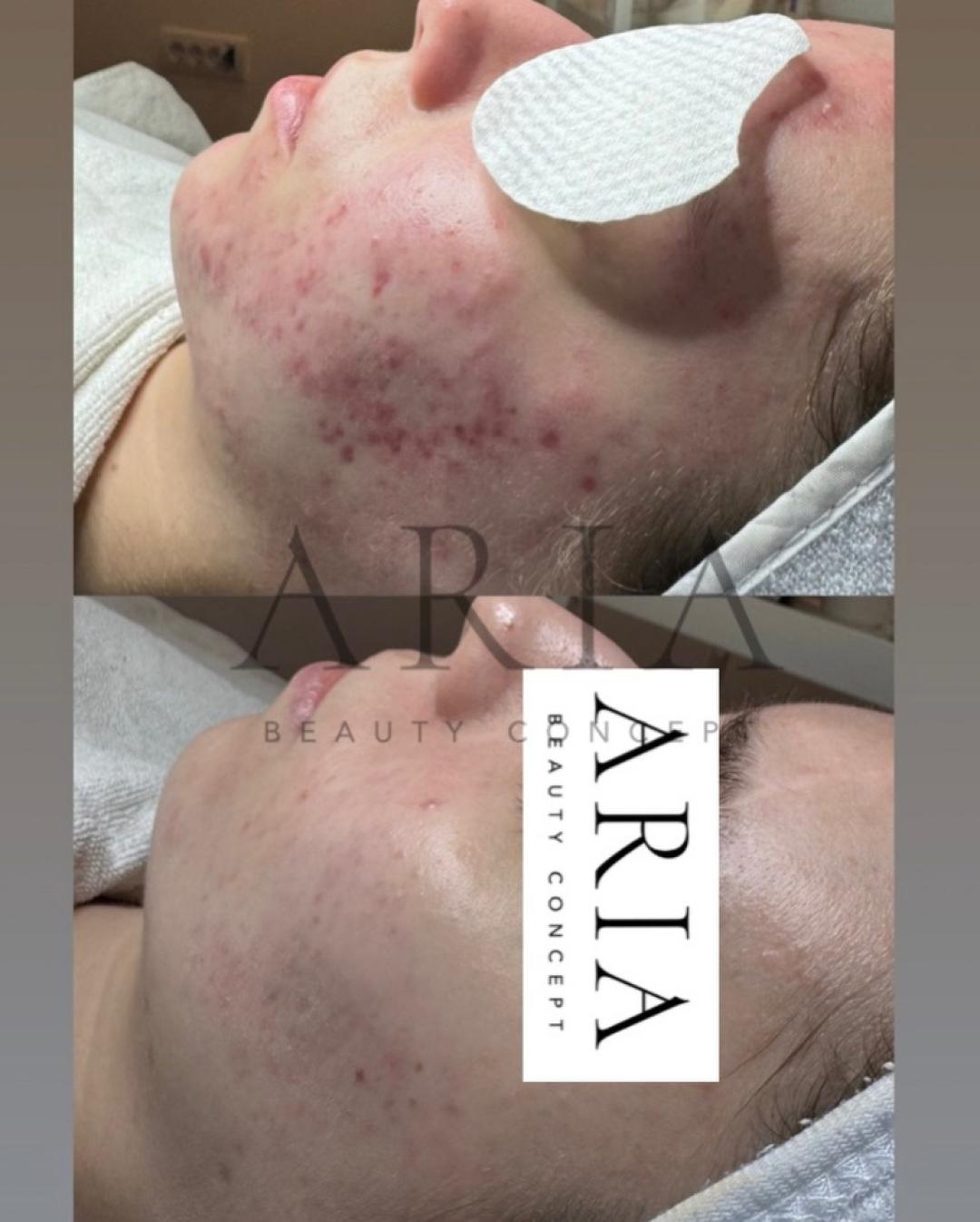 Aria Beauty Concept #pancevo Tretman lica Depigmentation solution tretman lica