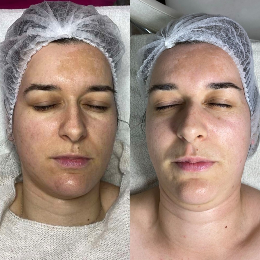 Studio joge i lepote Jelena Bilcar #beograd Tretman lica Mezoterapija + hemijski piling Mesoestetik