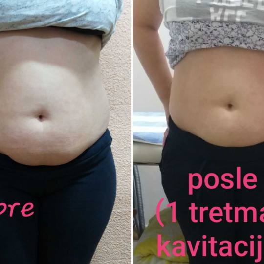 My little secret #beograd Kavitacija Kavitacija
