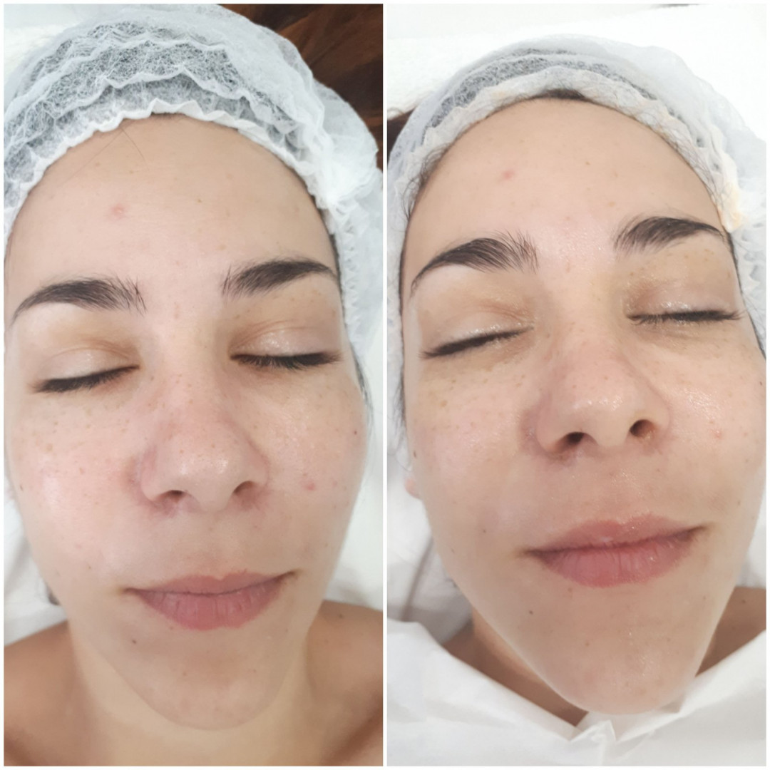 Essence of Beauty Academy #beograd Tretman lica Karbonski tretman lica