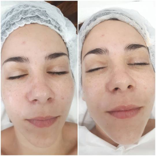 Essence of Beauty Academy #beograd Tretman lica Karbonski tretman lica Pre i posle BB Glow tretmana 