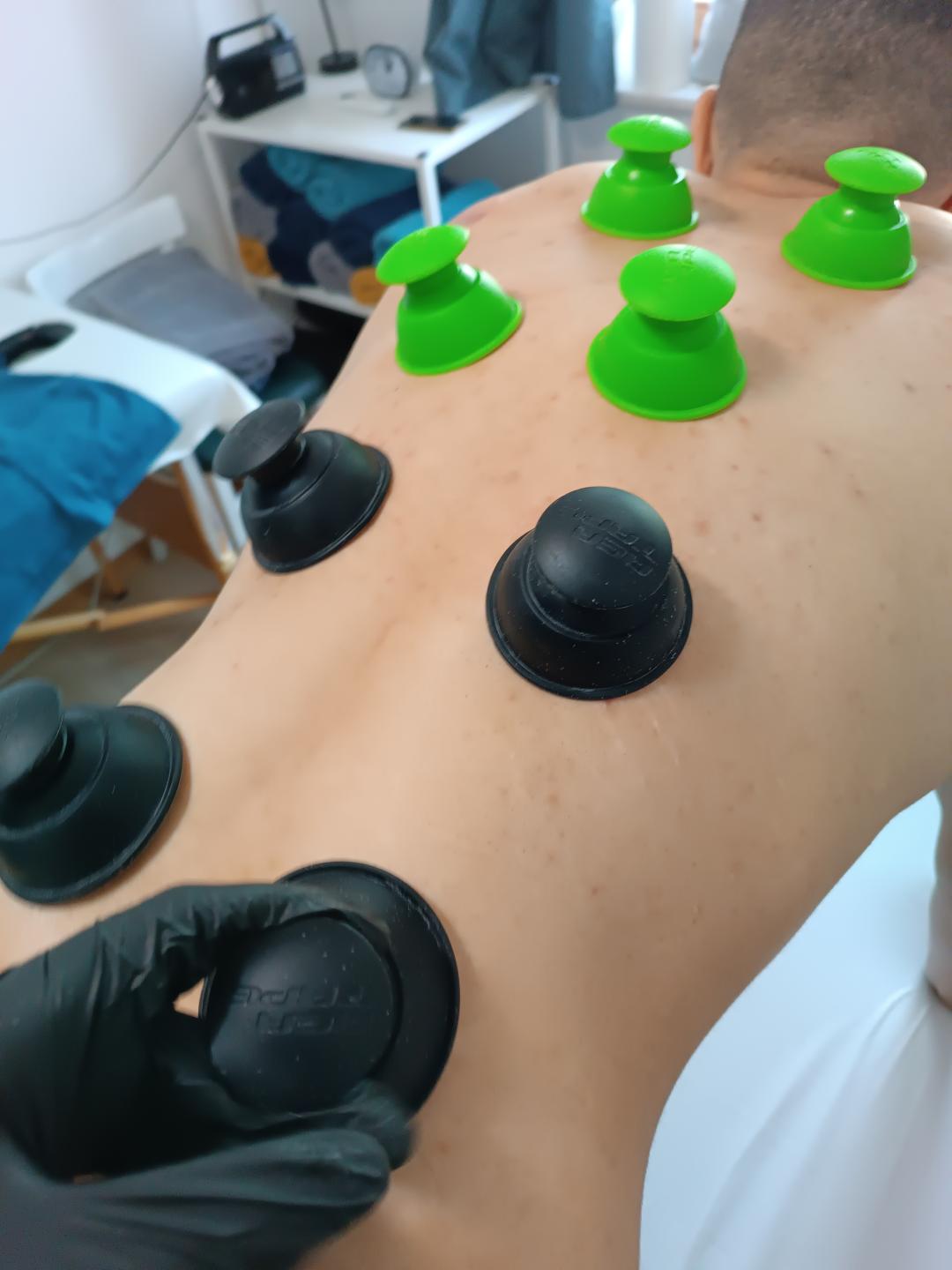 Neokinetika #novisad Tretmani tela Myofascialni cupping - ventuze