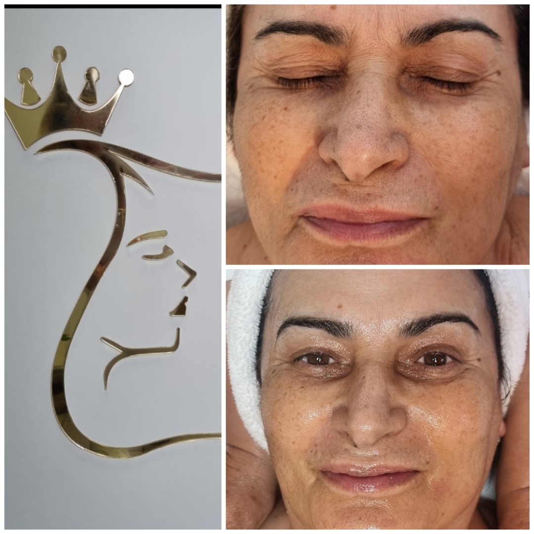 Emilly #beograd Tretman lica Skin boosters tretman lica