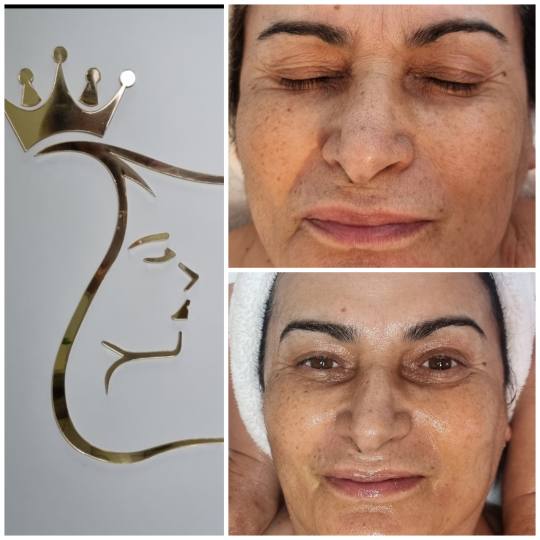 Emilly #beograd Tretman lica Skin boosters tretman lica Idealan tretman za dubiku hidrataciju kože 