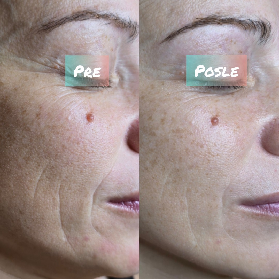 Mezoporacija koktela vitamina ultrazvukom - Laser lab by Ceca, Novi Sad Tretman lica Lice Tretman lica, Novi Sad, Grbavica, Liman, Adamićevo