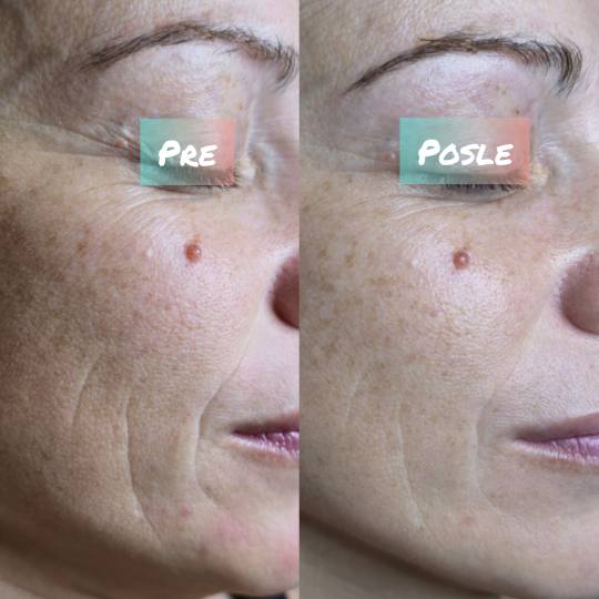Laser lab by Ceca #novisad Tretman lica Mezoporacija koktela vitamina ultrazvukom Tretman podrazumev