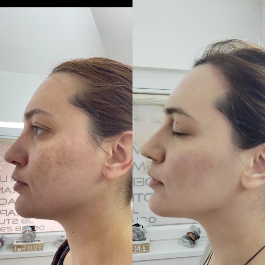 Studio joge i lepote Jelena Bilcar #beograd Tretman lica Mezoterapija + hemijski piling Mesoestetik