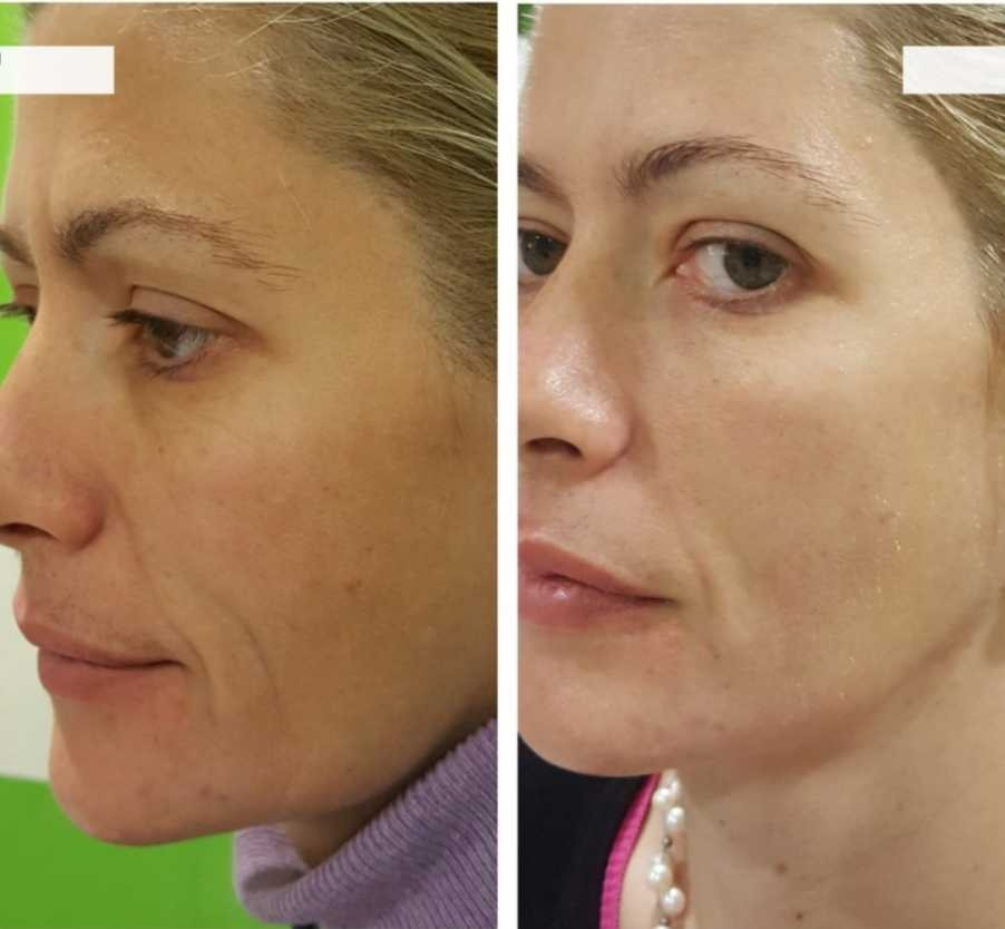 Estetik Studio Lira #beograd Lifting / zatezanje kože HIFU - celog lica