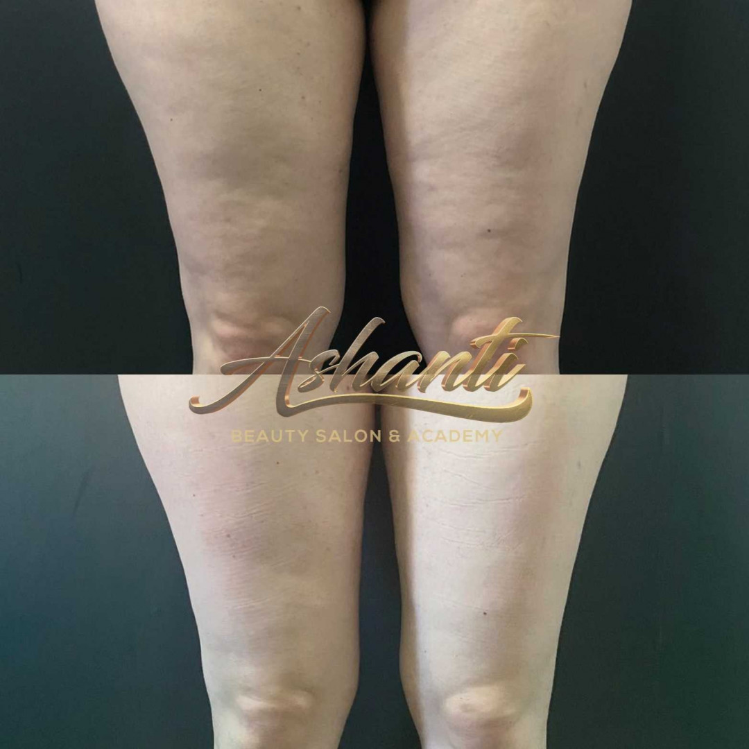 Ashanti Beauty Salon & Academy #beograd Anticelulit masaža Premium Maderoterapija - paket od 5 tretmana