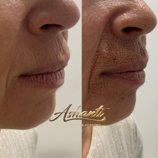 Ashanti Beauty Salon & Academy #beograd Tretman lica Plasma pen - marionetske bore