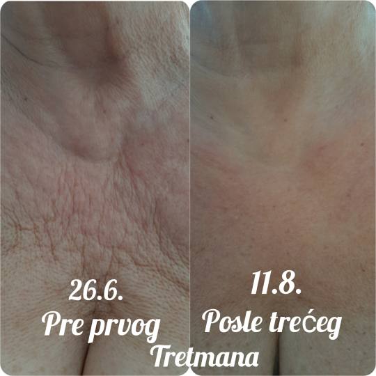 Studio Venera J #beograd Tretman lica Derma Fix tretman lica sa kolagenskim nitima