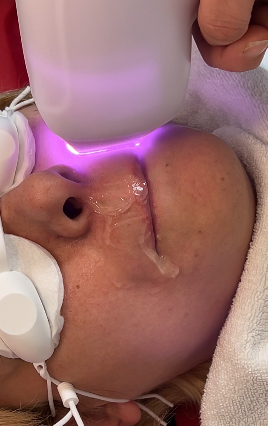 Odraz lepote #beograd Laserska epilacija Laserska epilacija malih regija (nausnice, podbradak, brada ili zulufi) - za dame